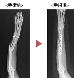 橈尺骨骨折の症例