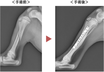 脛骨骨折の症例